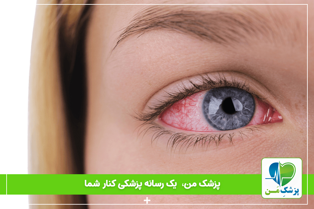 خونریزی چشم: علت، علائم و درمان