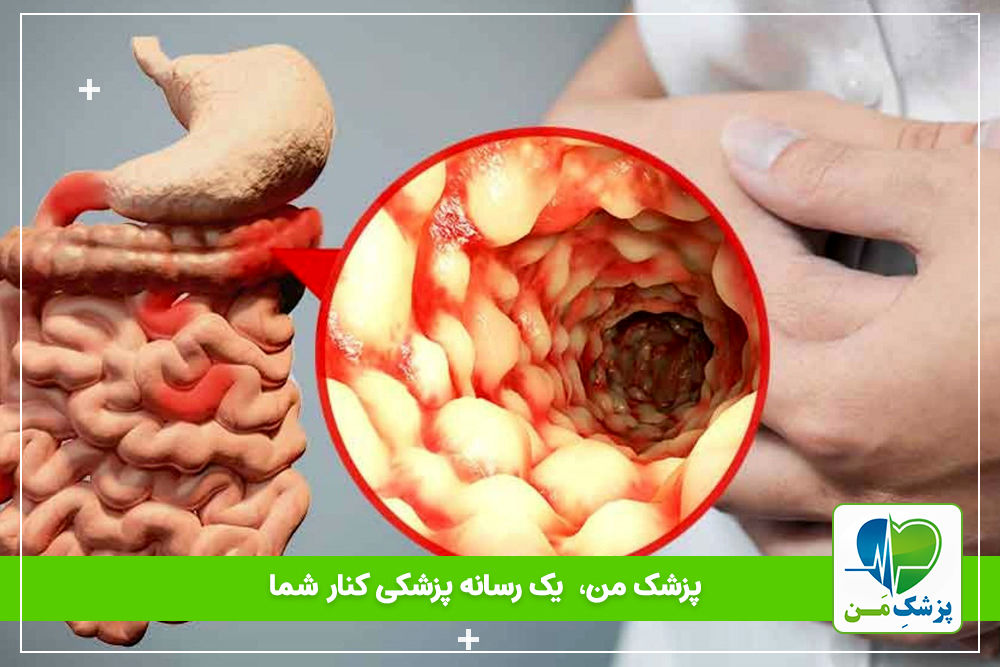 بیماری گوارشی کرون چه تاثیری بر بدن می‌گذارد!؟