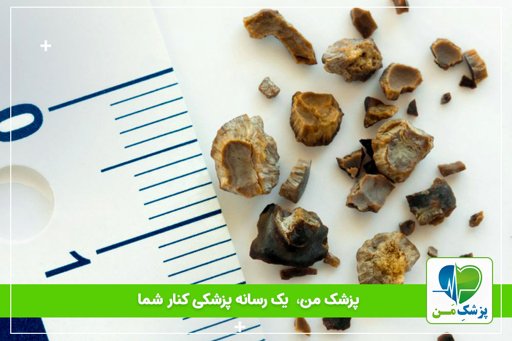 سنگ شکن کلیه چیست؟
