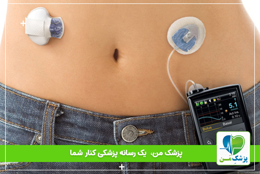 صفر تا صد پمپ انسولین برای دیابتی ها