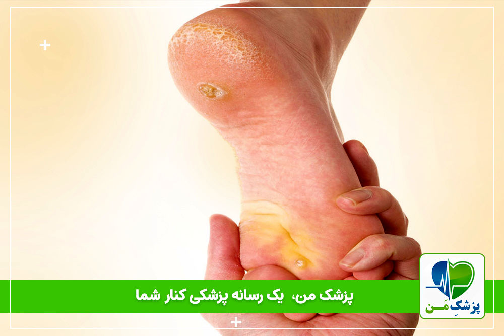 زخم پای دیابتی چیست؟ راه های درمان و پیشگیری