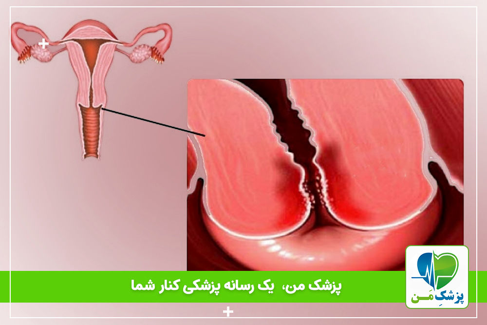 علل زخم دهانه رحم و راه های درمان آن