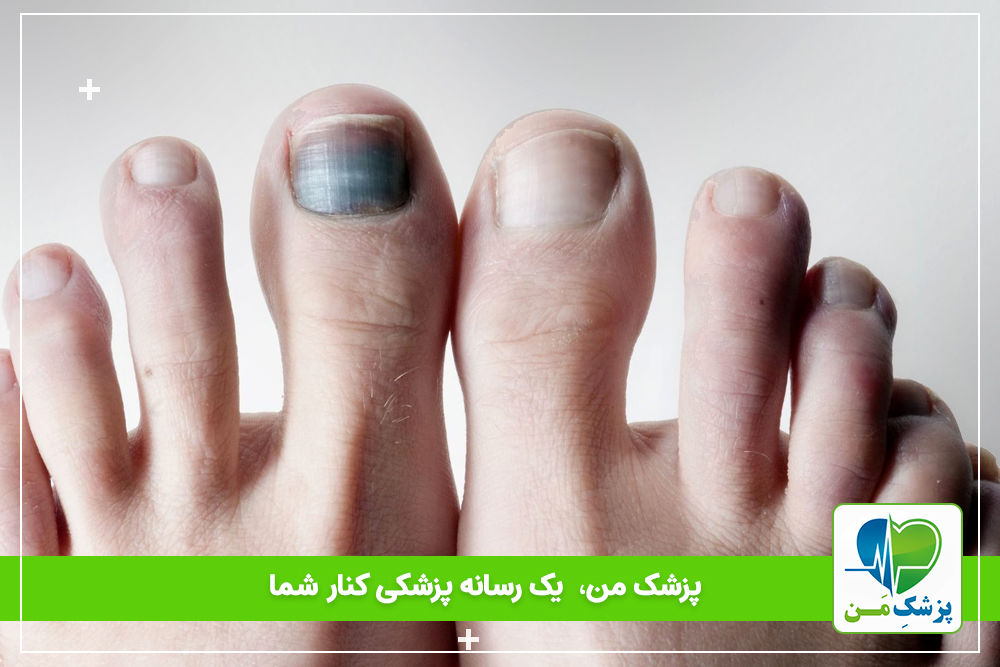 سیاه و تیره شدن ناخن پا در دیابت