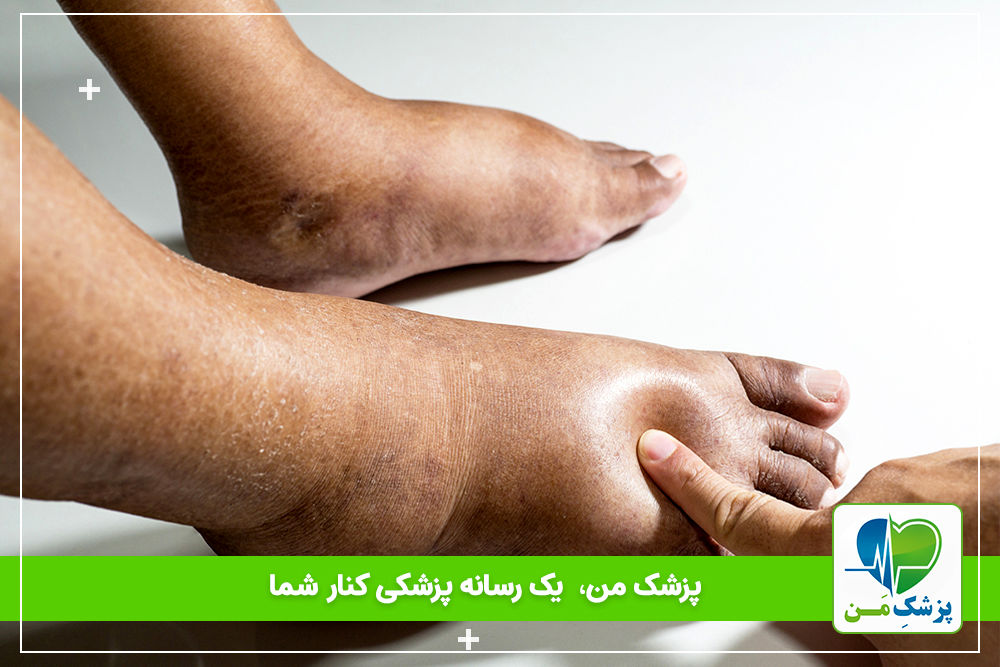 علت ورم پا دیابتی ها!