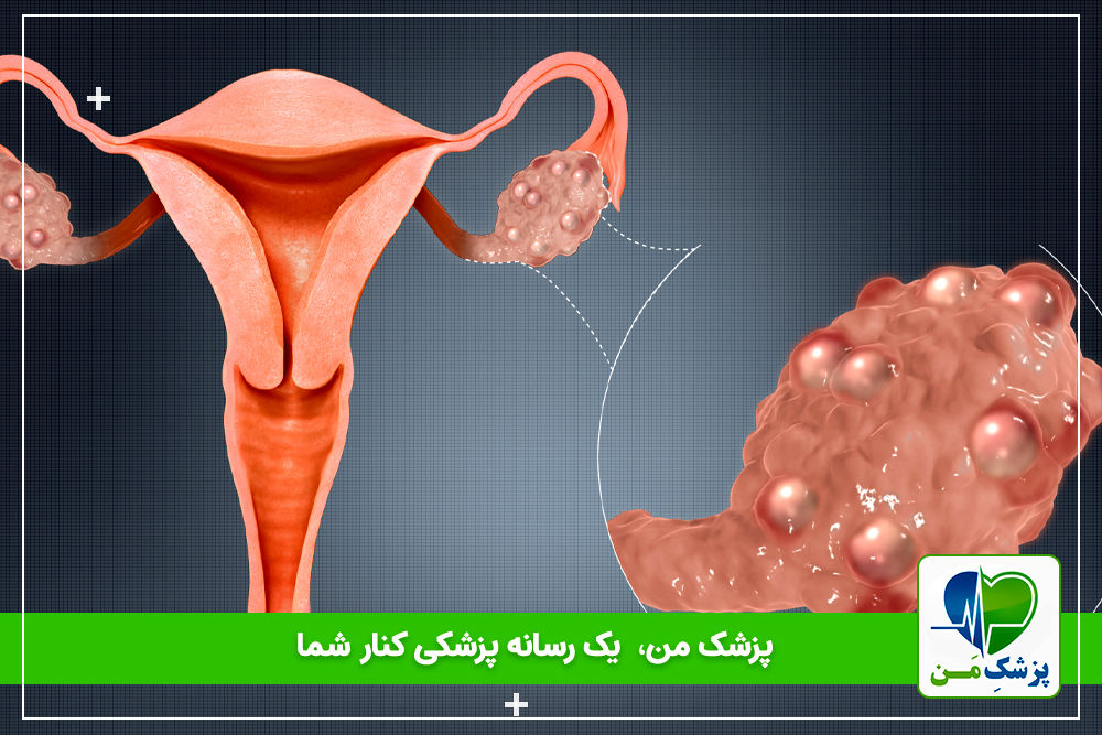 علائم و راه‌ های تشخیص بیماری تخمدان پلی کیستیک