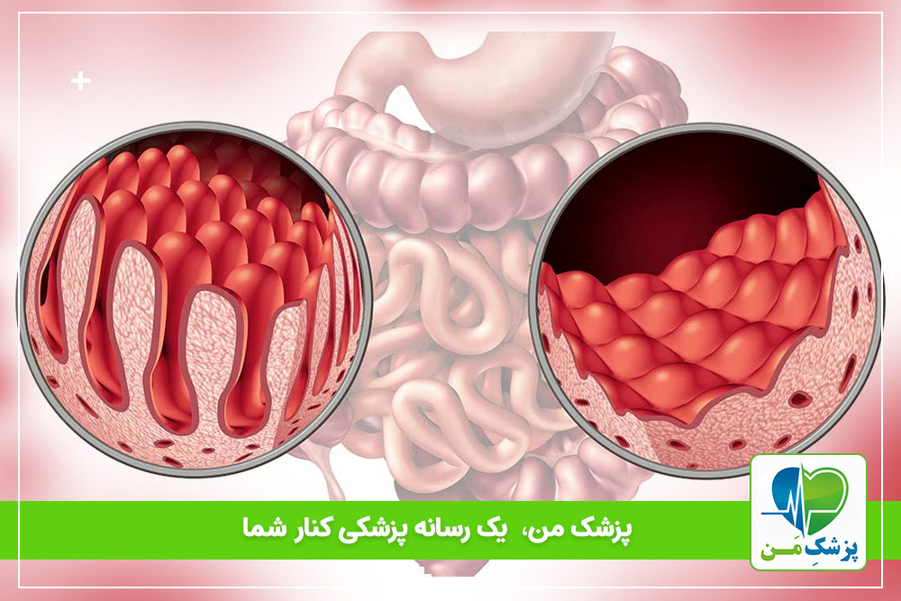 همه چیز درباره بیماری سلیاک