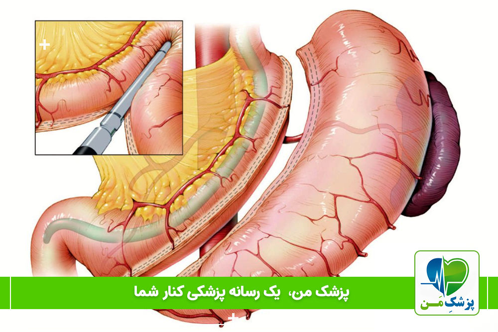 اسلیو معده چیست و چه عوارضی به همراه دارد؟