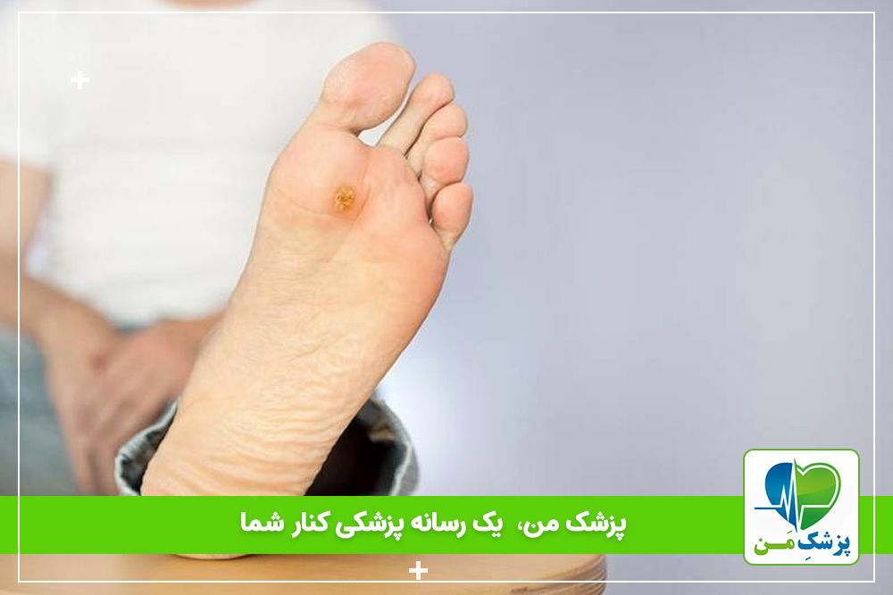 افراد دیابتی که زخم پا دارند حتما توجه کنند!