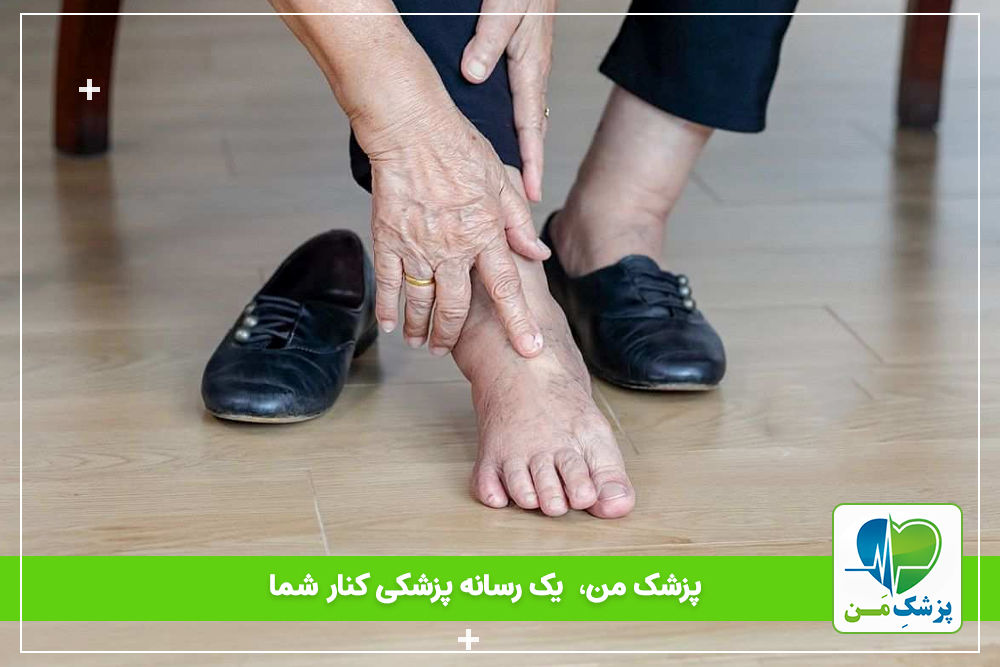 دلایل ورم پا در دیابتی ها؟