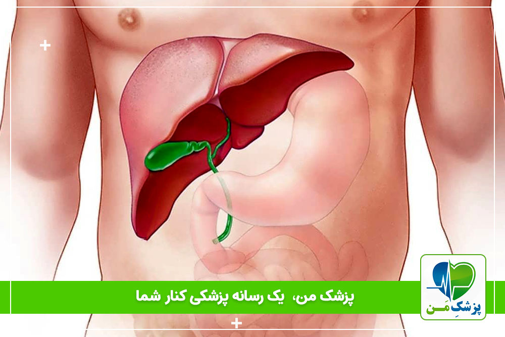 کبد چرب گرید1 ( علائم، پیشگیری و درمان آن)