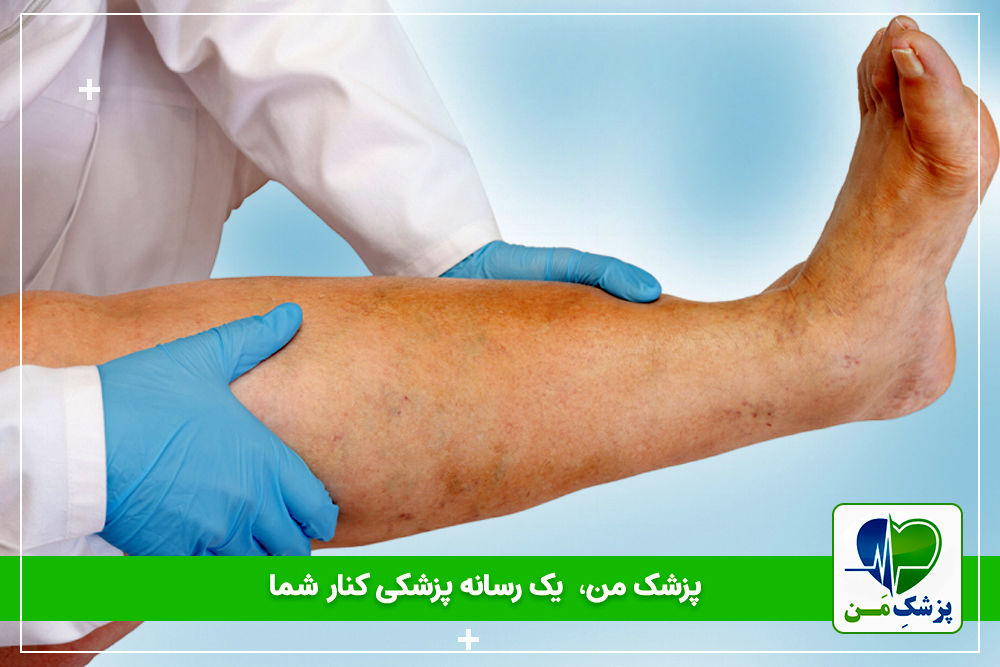 علائم گرفتگی عروق پا در دیابتی ها!