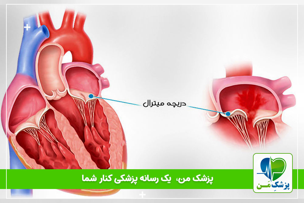 افتادگی دریچه میترال!!!