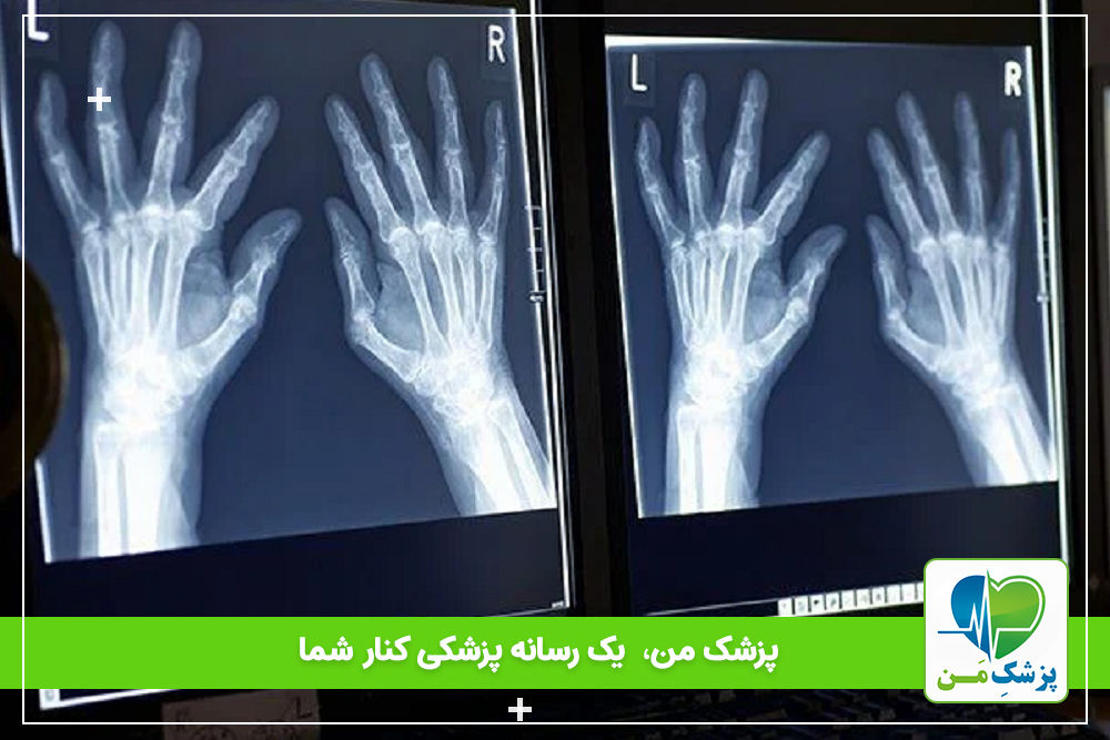 تشخیص آرتریت با استفاده از MRI