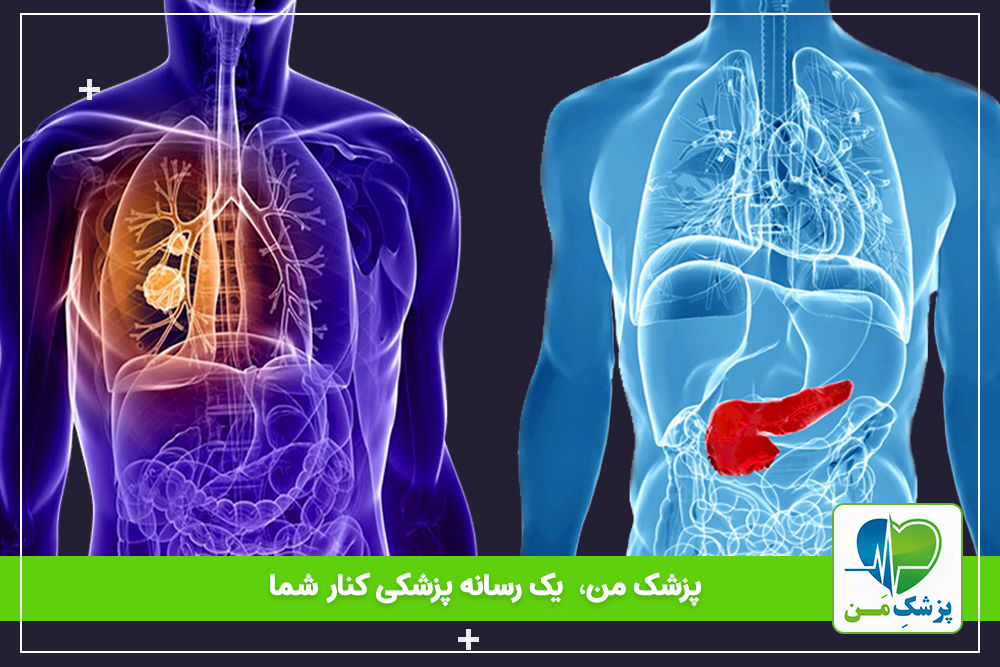 ارتباط فیبروز کیستیک با نارسایی برون ریز پانکراس(EPI)