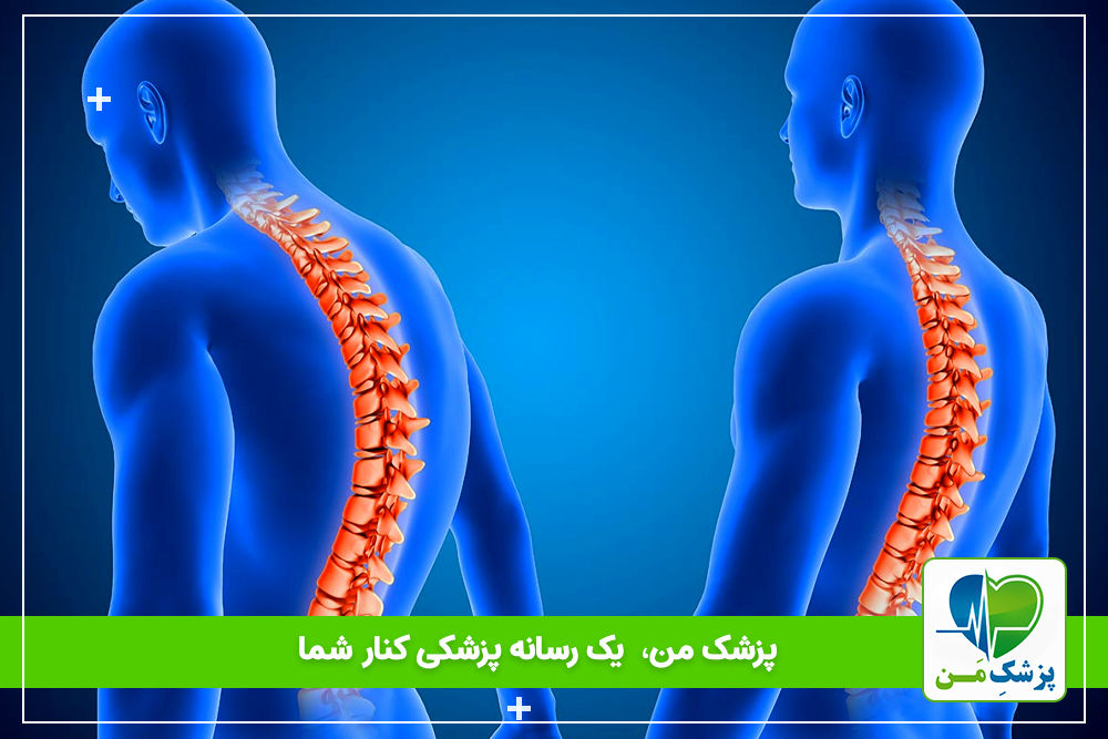 درمان انحنای ستون فقرات با جراحی همجوشی