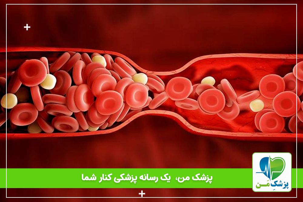 علت لخته شدن خون در پیشگیری از بارداری