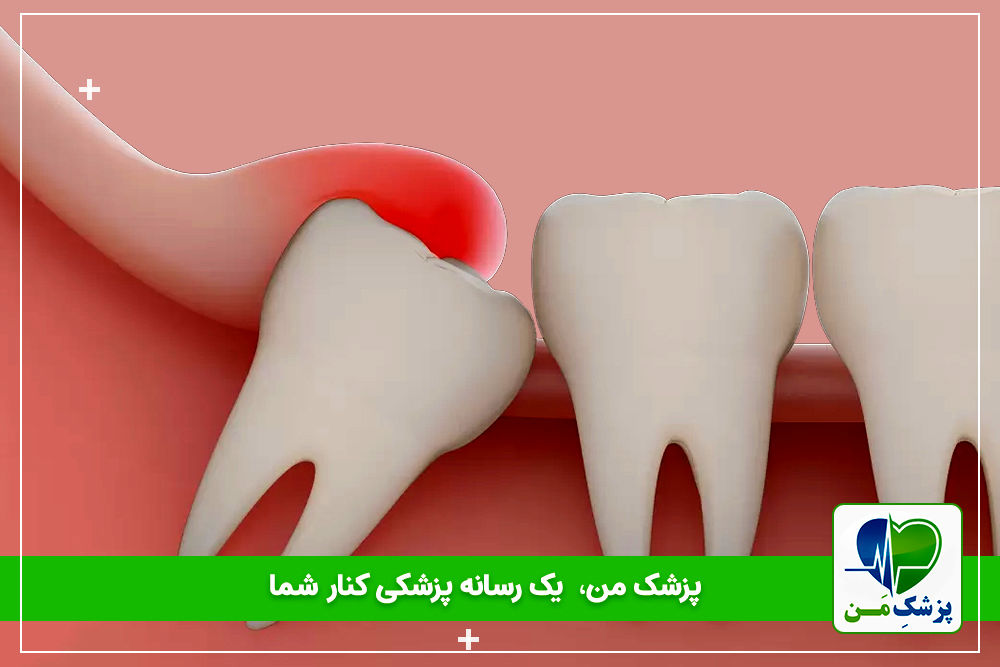 دندان عقل چیست؟ – رشد، تشخیص و کشیدن دندادن عقل