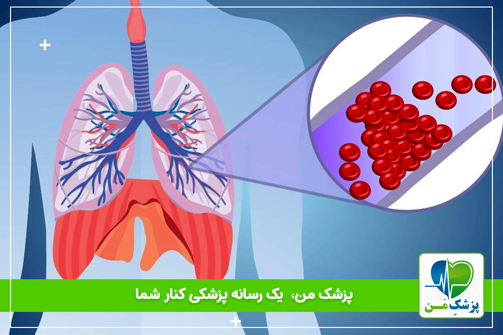 علائم آمبولی قلب و درمان آن