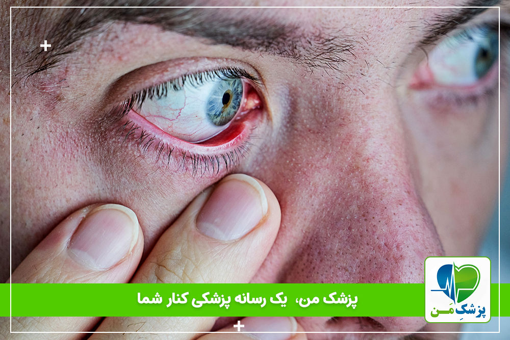 علت خشکی چشم و جلوگیری از آن