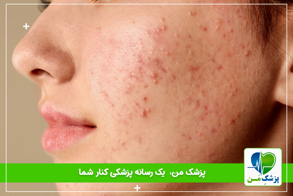 آنچه در مورد جوش بزرگسالان باید بدانید