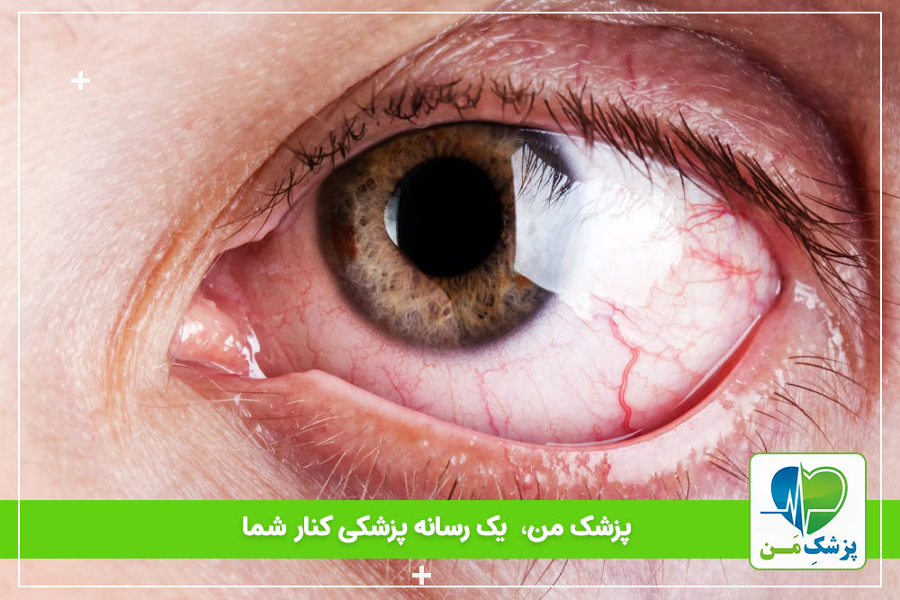 سندرم خشکی چشم و آنچه باید بدانید