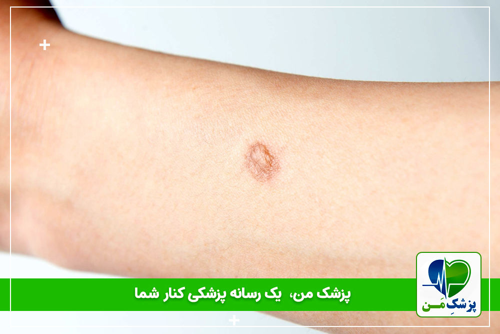 علت گوشت اضافه یا کلوئید چیست؟ و راه های درمان