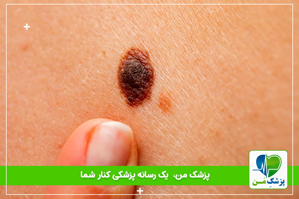 آنچه در مورد خال های سرطانی باید بدانید