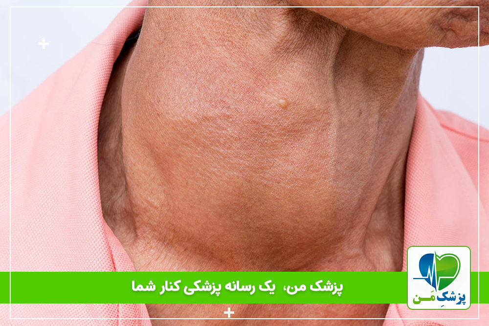 تیروئید هاشیموتو چیست؟