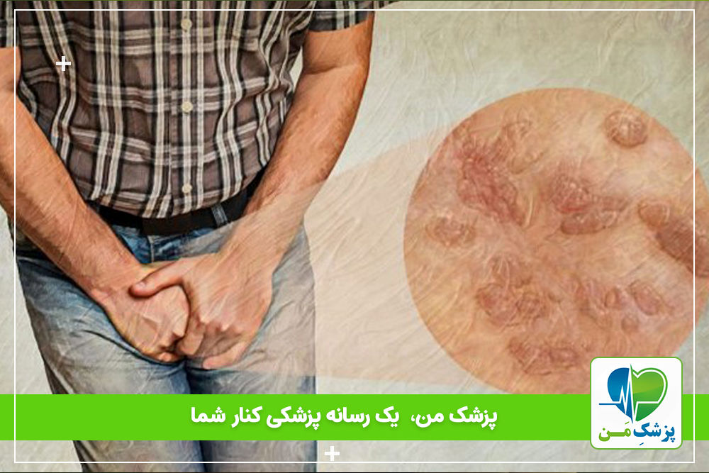زگیل تناسلی چیست؟