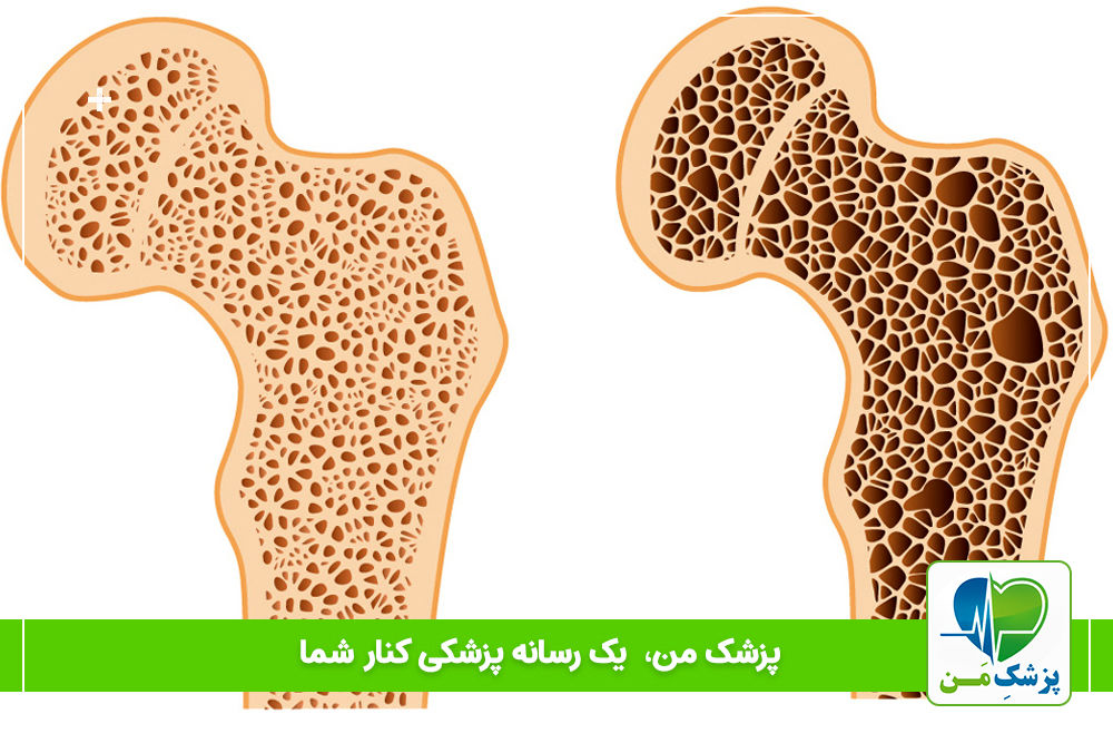 آیا دیابت شیرین یک عامل خطر برای کاهش تراکم استخوان است؟