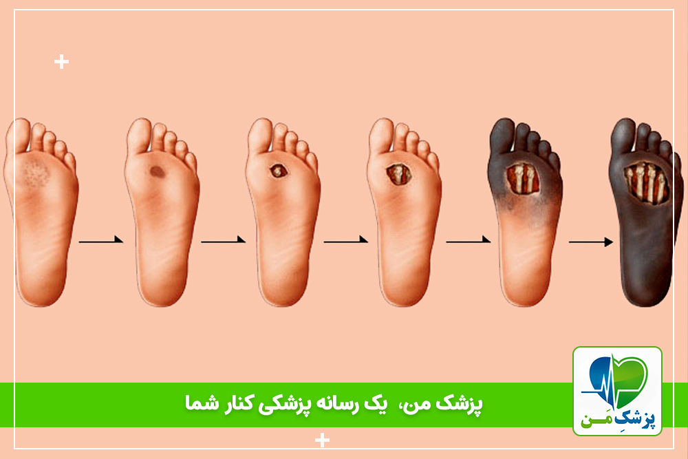 راه های پیشگیری از زخم پای دیابتی و راه های درمان آن