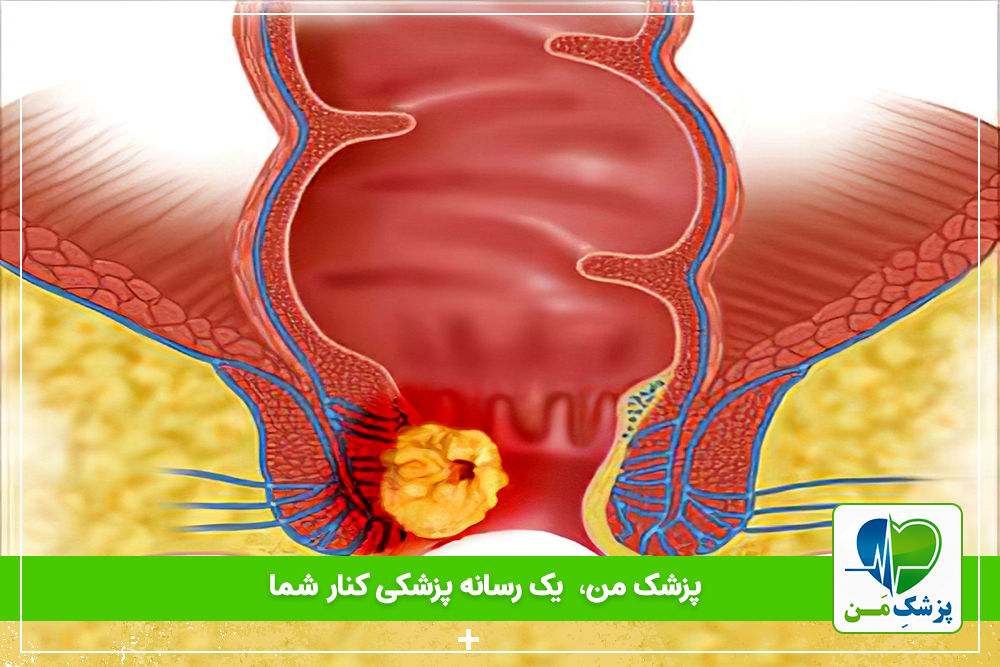 عوامل خطر سرطان مقعد چیست؟