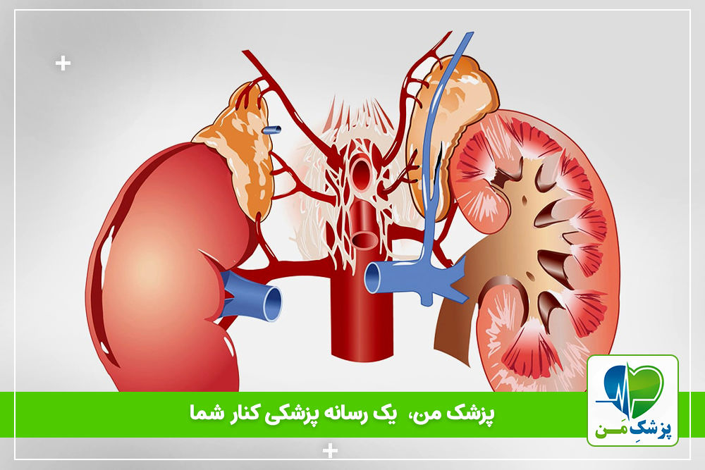 بحران آدرنال یا آدیسون چیست؟