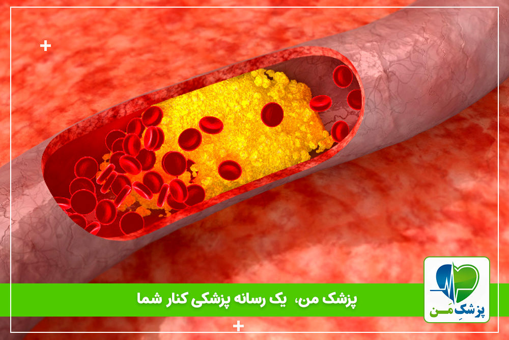 اهمیت کنترل چربی ها در افراد دیابتی
