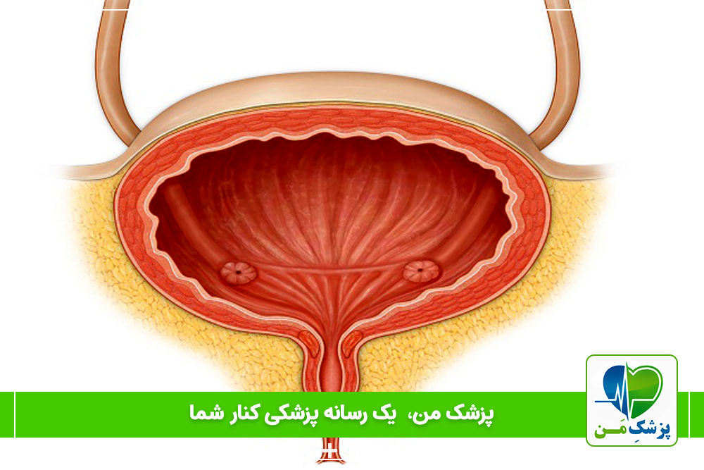 تومور مثانه چیست؟ علائم و راه های درمان