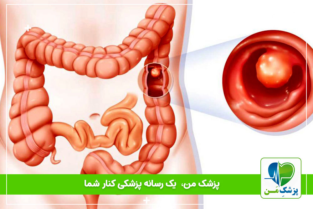 پولیپ روده و تاثیر آن بر افزایش خطر سرطان