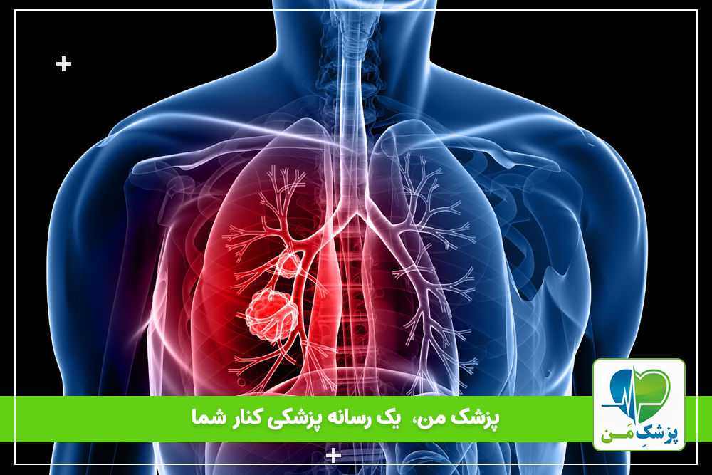 عوارض(COPD)، بیماری انسدادی مزمن ریوی چیست؟