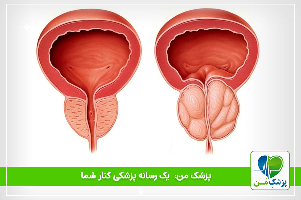دلایل بزرگ شدن خوش خیم پروستات چیست؟