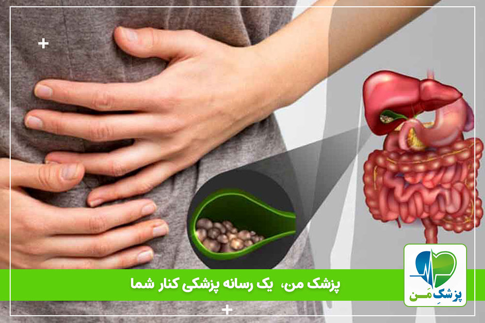 اضافه وزن و تولید سنگ های صفراوی