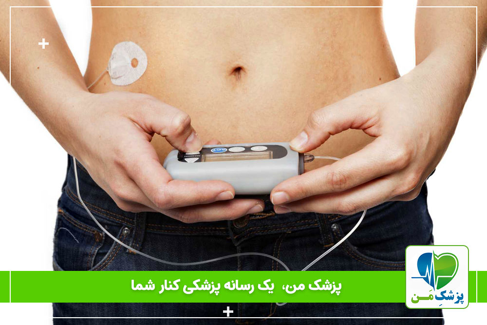 صفر تا صد پمپ انسولین برای دیابتی ها